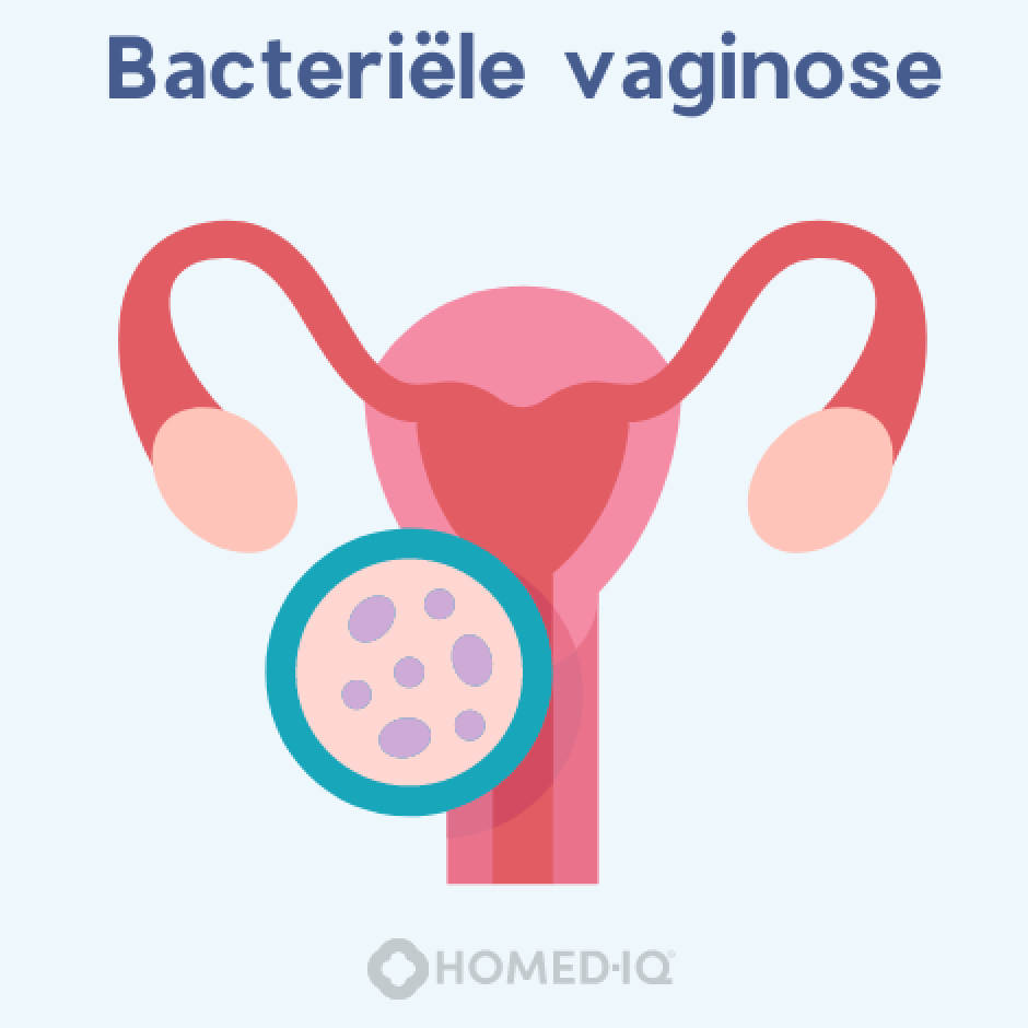 Trichomoniasis en Bacteriële Vaginose: Belangrijke Verschillen die je Moet Weten - Homed-IQ